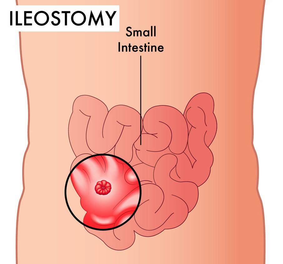 ileostomy from the front